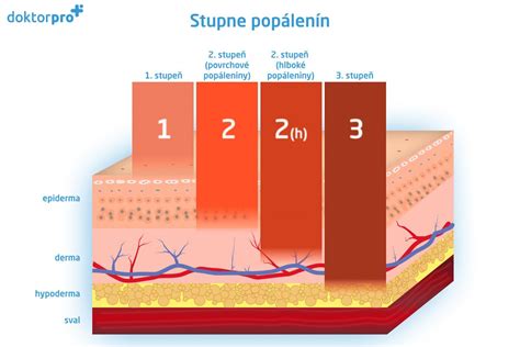Klasifikácia stupňov popálenín