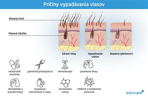 Grafické znázornenie vypadávania vlasov po pôrode