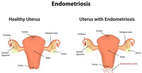Schéma implantácie: embryo do endometria