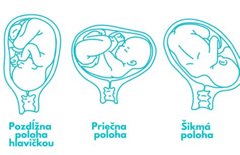 Grafické znázornenie polôh plodu v maternici