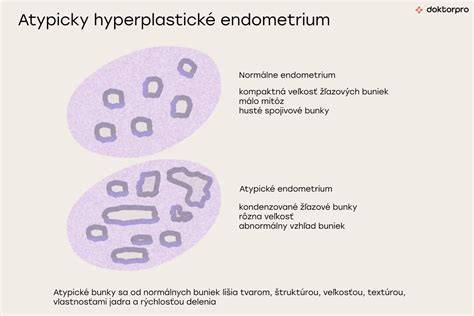 Infografika: Typy hyperplázie endometria a riziká pre transformáciu na rakovinu