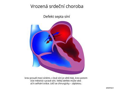 Defekt predsieňového septa u novorodencov: príznaky a liečba