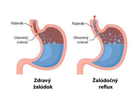 Infografika o tom, ako funguje reflux a čo ho zhoršuje počas tehotenstva