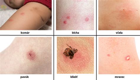 Uštipnutie hmyzom: Ako rozpoznať, liečiť a predchádzať