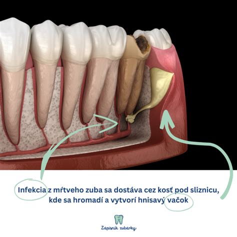 Ilustrácia komplikácií pri vytrhnutí zuba