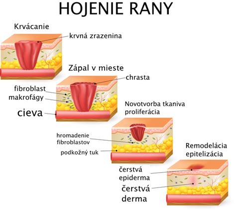 Infografika znázorňujúca proces hojenia rany po extrakcii zuba