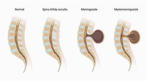 Infografika: Typy spina bifida a ich charakteristiky