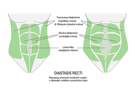 Infografika: diastáza brušných svalov - priebeh a diagnostika
