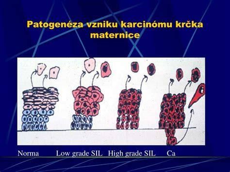 Infografika: Usmernenie liečby karcinómu krčka maternice podľa štádia