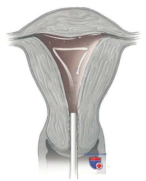 Endometrium a jeho vrstvy: bazálna a funkčná vrstva