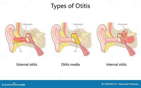 Table: Porovnanie typov zápalu ucha (otitis externa, otitis media, labyrinthitída)