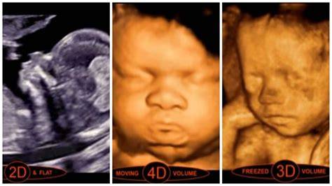 Infografika: Rozdiely medzi 2D, 3D a 4D ultrazvukom a čo skúma morfologický ultrazvuk