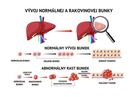 Schéma zobrazujúca princíp vyhladovania rakovinových buniek