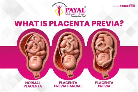 Infografika: Placenta previa - typy a diagnostika
