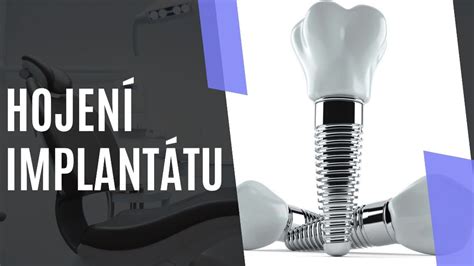 Ilustrácia kochleárneho implantátu