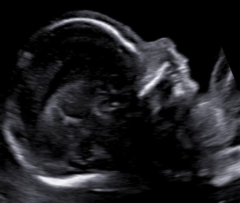 Schéma priebehu druhotrimestrálneho skríningu a naviazanie na genetický ultrazvuk