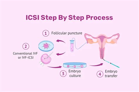 Schéma procesu IVF/ICSI