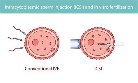 Grafický prehľad postupov IVF a ISCI