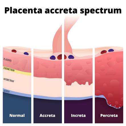 Infografika: Rozdelenie typov placenty accreta podľa hĺbky invázie do steny maternice (adherens, accreta, increta, percreta)