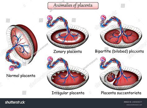 Schéma: normálna placenta vs. placenta circumvallata (znížená chorionická platňa, zdvihnutý okraj, prstencový vzhľad)