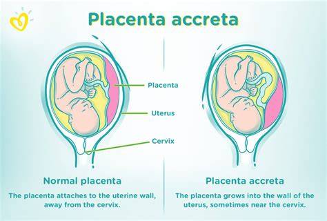 Klasifikácia placenty podľa intimity spojenia: ako sa líši priľnutie placenty k maternici a čo to znamená pre tehotenstvo