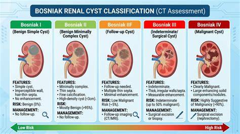 Infografika: typy cyst a diagnostické stupne Bosniak