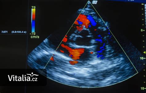 Ultrazvuk: Všadeprítomný, ale nepočutý