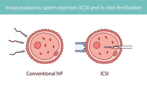 Infografika vysvetľujúca rozdiely medzi metódami IUI, IVF a ICSI.