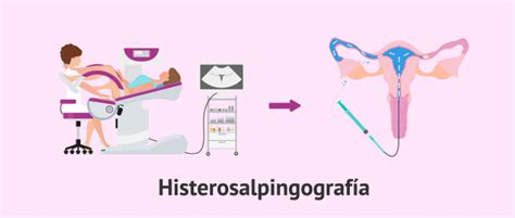 Schéma vyšetrenia hysterosalpingografia (HSG)