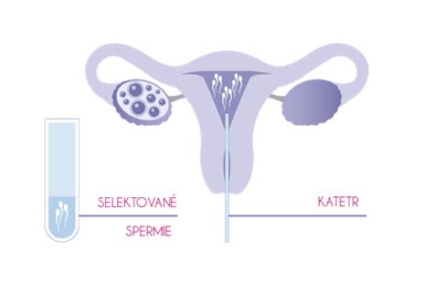 Intrauterinná inseminácia (IUI): Cesta k otehotneniu