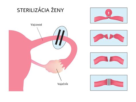 Sterilizácia cumlíkov