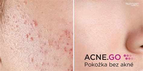Obrázok znázorňujúci zlepšenie stavu pleti po liečbe akné