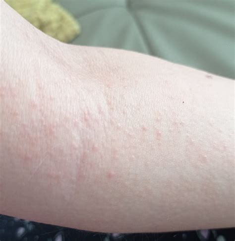 Ilustrácia vyrážok na rukách, nohách a v ústach