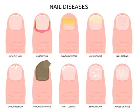 Ilustrácia odlupujúcich sa nechtov