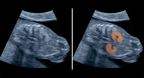 ultrazvuk maternice v prvom trimestri