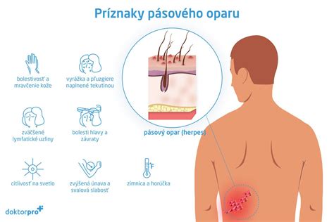 Schéma priebehu pásového oparu