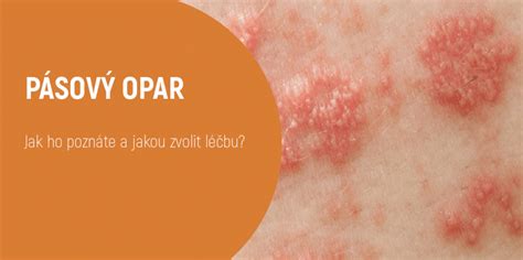 Pásový opar (Herpes Zoster) a jeho súvislosti s tehotenstvom: Príznaky a liečba
