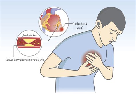 Infografika rizikových faktorov ischemickej choroby srdca