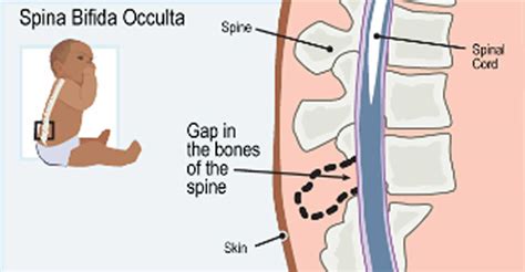 rehabilitácia dieťaťa so spina bifida