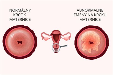 Grafické znázornenie dĺžky krčka maternice v rôznych fázach tehotenstva a pôrodu