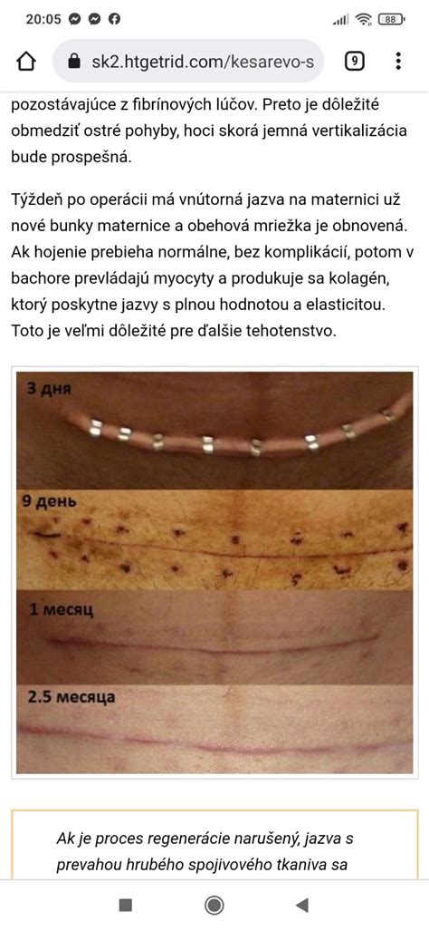 Typy jaziev po cisárskom reze