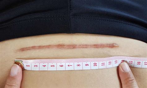 Vzhľad jazvy po cisárskom reze