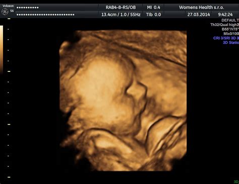 ultrazvukové vyšetrenie plodu v 12. týždni