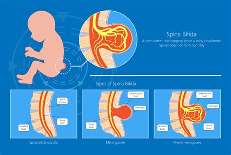 Infografika o spina bifida a možnostiach fetálnej chirurgie
