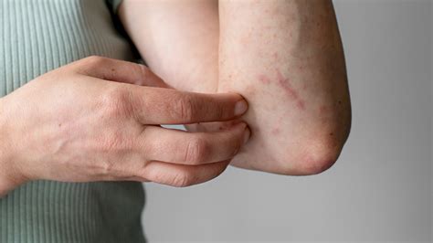 Červená predkožka: Príčiny, príznaky a liečba