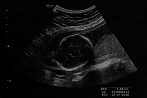 ultrazvuk plodu v druhom trimestri