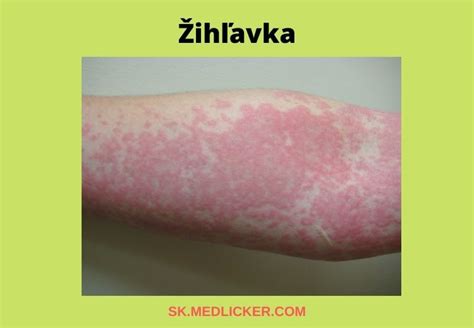 Žihľavka u detí a tehotenstvo: príznaky, príčiny a liečba
