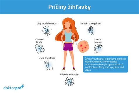 Infografika znázorňujúca príznaky žihľavky