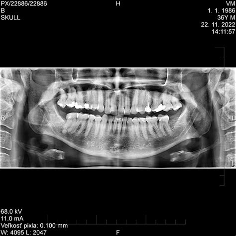 Rentgenový snímok zubov s viditeľným opotrebením