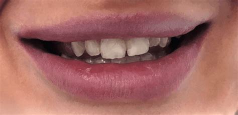 Bruxizmus: Príčiny, Príznaky a Riešenia Škrípania Zubami